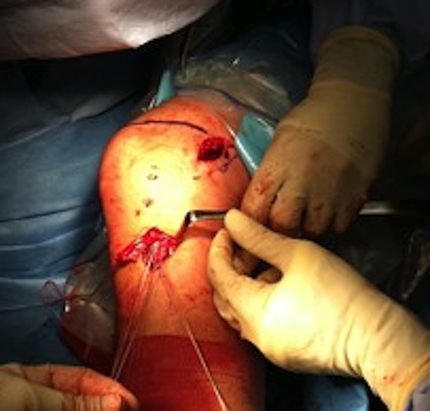 MCL Reconstruction 2 Incision